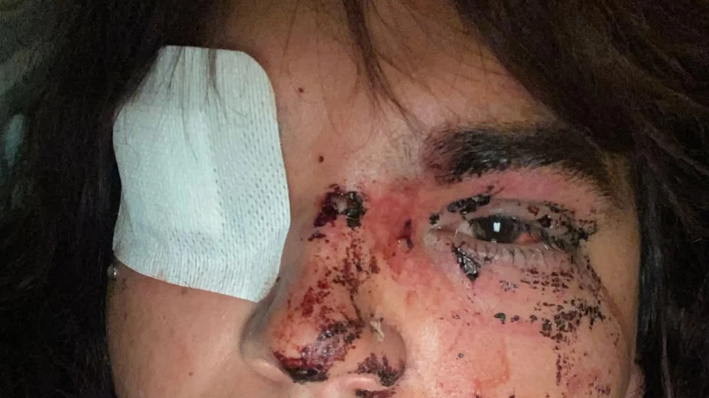 Bianca enseña las heridas que sufrió tras ser agredida por cinco mujeres Bianca enseña las heridas que sufrió tras ser agredida por cinco mujeres