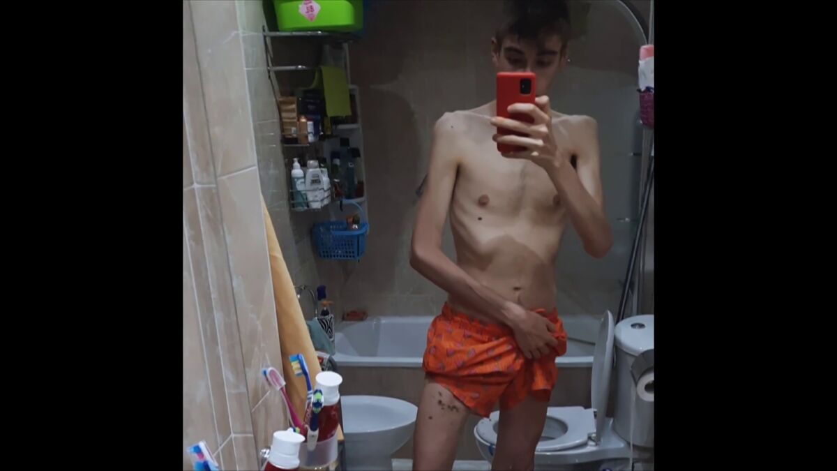 El duro testimonio de Miguel, un joven con anorexia nerviosa: 