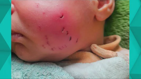 Bebé mordido por una rata en Gaza Bebé mordido por una rata en Gaza