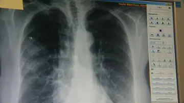 Un equipo de investigadores descubre una proteína que aporta más información sobre el cáncer de pulmón Un equipo de investigadores descubre una proteína que aporta más información sobre el cáncer de pulmón