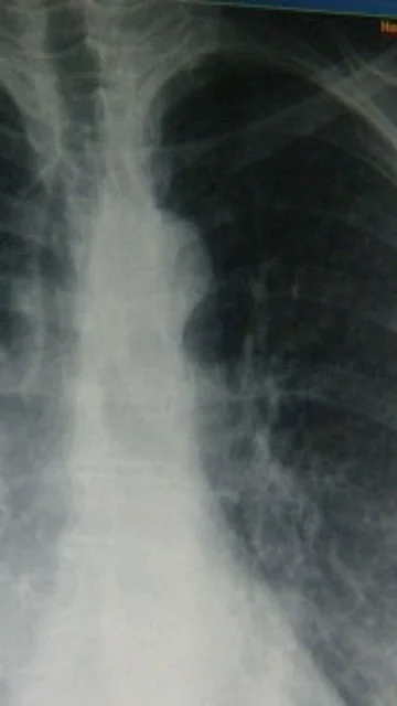 Un equipo de investigadores descubre una proteína que aporta más información sobre el cáncer de pulmón