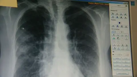 Un equipo de investigadores descubre una proteína que aporta más información sobre el cáncer de pulmón Un equipo de investigadores descubre una proteína que aporta más información sobre el cáncer de pulmón