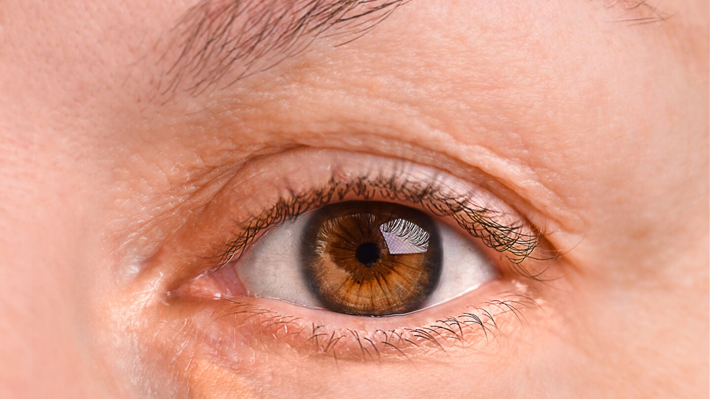 Ojo de una mujer con xantelasma