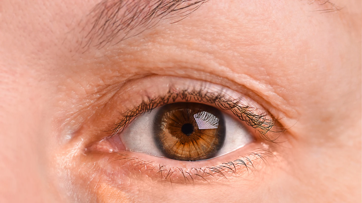 Ojo de una mujer con xantelasma Ojo de una mujer con xantelasma