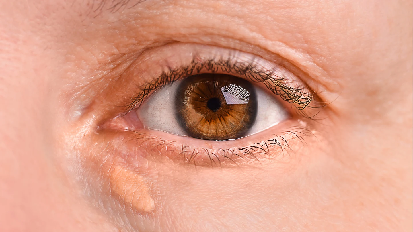 Ojo de una mujer con xantelasma Ojo de una mujer con xantelasma