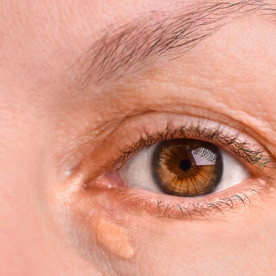 Ojo de una mujer con xantelasma