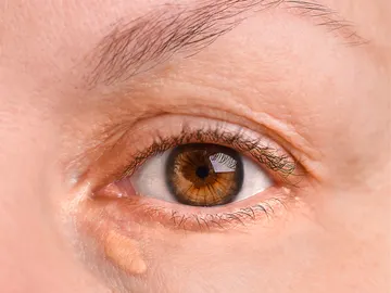 Ojo de una mujer con xantelasma Ojo de una mujer con xantelasma