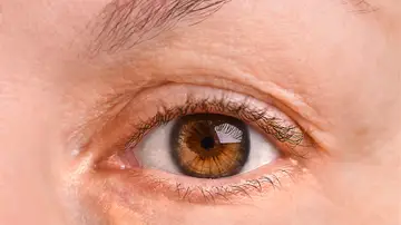 Ojo de una mujer con xantelasma Ojo de una mujer con xantelasma