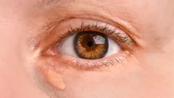 Ojo de una mujer con xantelasma Ojo de una mujer con xantelasma