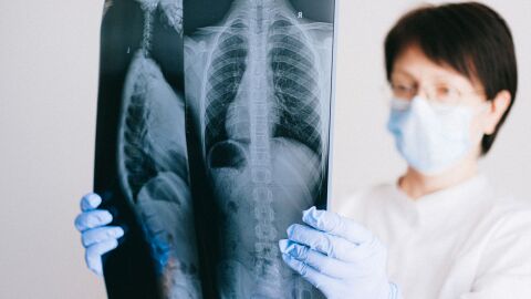 El papa León XIV será operado de un nódulo pulmonar: qué es esta lesión y cuándo puede ser maligna